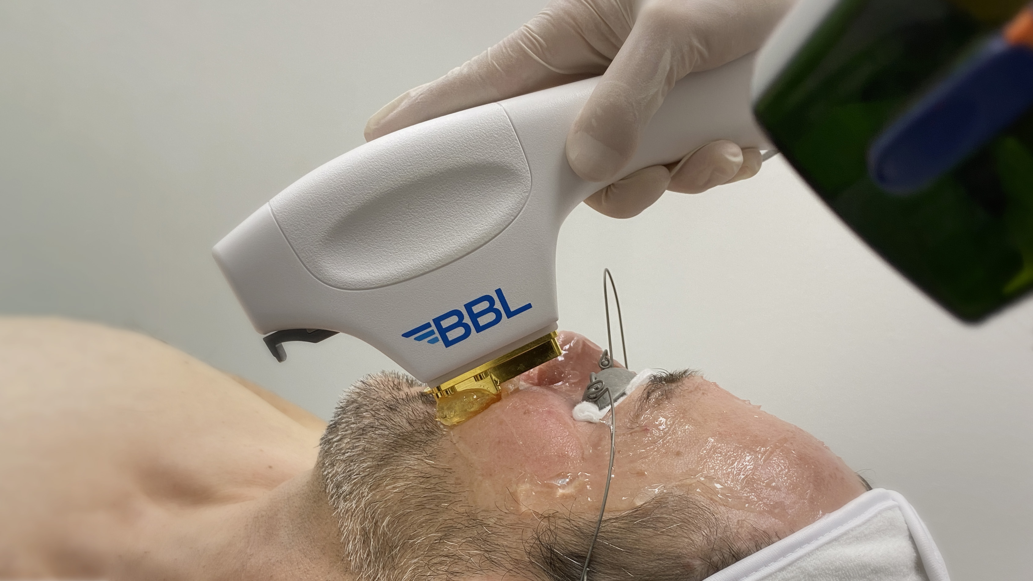 Ipl Laser For Rosacea Cosmetic Surgery Tips